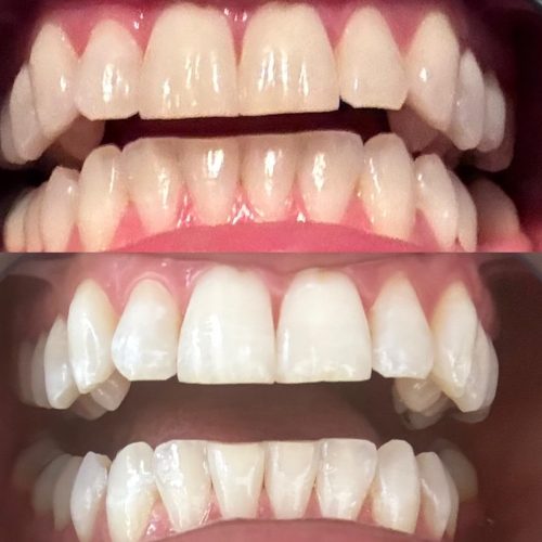 PurpleWhite Strips — Advanced Colour Correcting Formula (42 Pcs) photo review